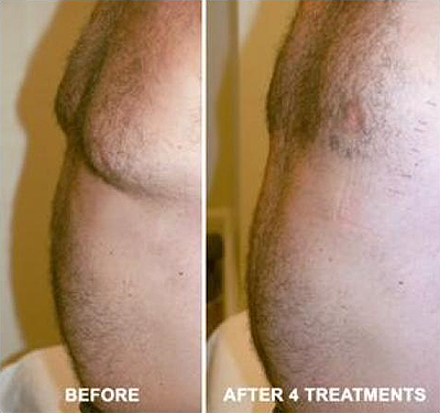 Perfectly You > Strawberry Laser Lipo > Stomach Before & After