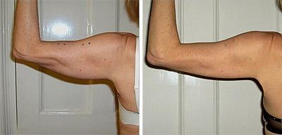 Perfectly You > Strawberry Laser Lipo > Stomach Before & After